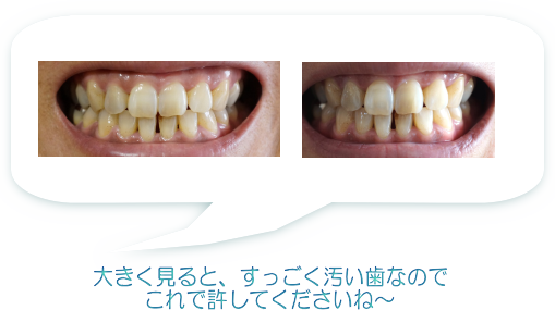 歯の写真